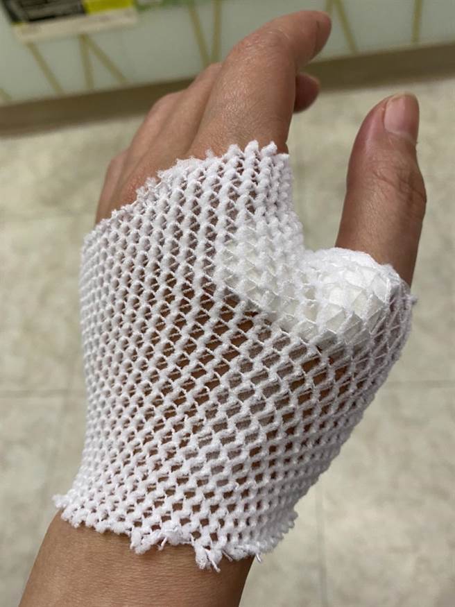 陈亚兰手受伤。（欣湉国际提供）