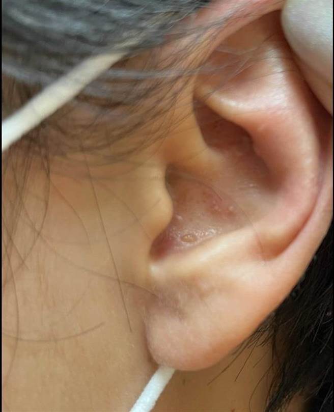 带状疱疹长在头颅部位，病毒会攻击神经，造成较为严重的后遗症。（亚大医院提供／冯惠宜台中传真)