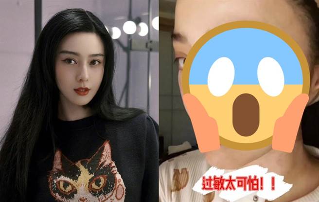范冰冰的好肤质因过敏变得红通通。（图／微博、小红书@范冰冰）