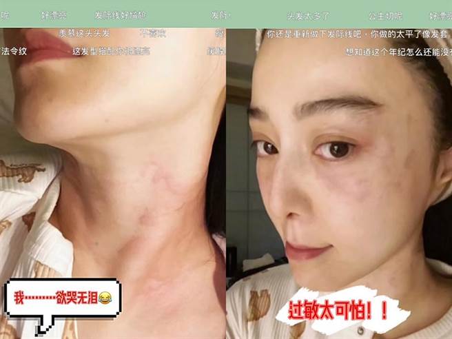 范冰冰脸部、脖子都过敏，让她欲哭无泪。（图／小红书@范冰冰）