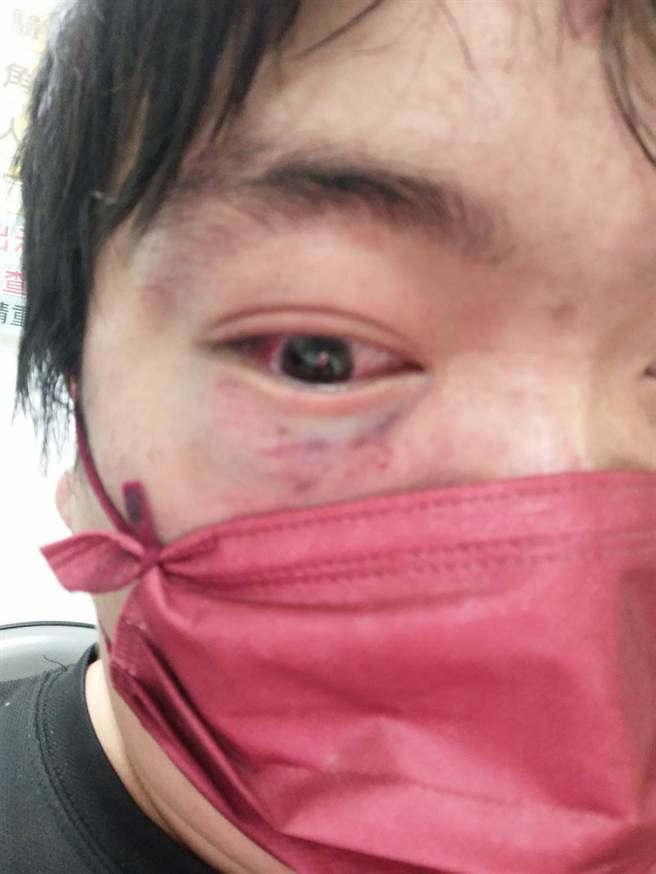 梁男遭柳男毆傷眼睛嚴重瘀青眼白紅腫，多處挫傷「眼眶碎裂」。（民眾提供／陳世宗台中傳真）