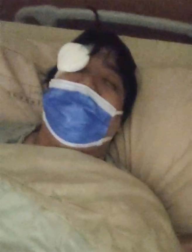 梁男回診時醫師發現「眼眶碎裂」，安排於3月2日動手術、5日才出院。（民眾提供／陳世宗台中傳真）