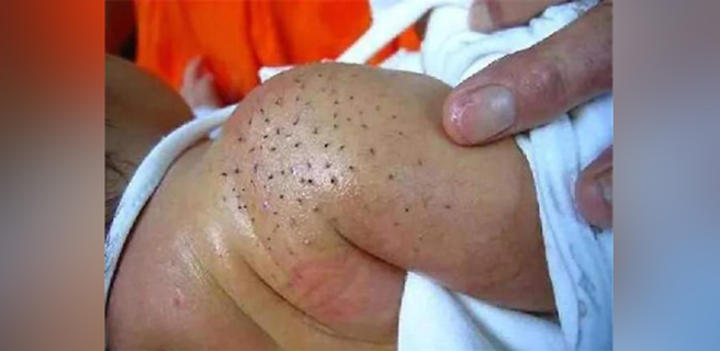 很多时候，「猪毛风」都是由于家长搓揉宝宝皮肤引起的，在搓揉过程中胎脂或者其他人为添加的物质容易与细毛缠绕在一起。（图／翻摄自微博）