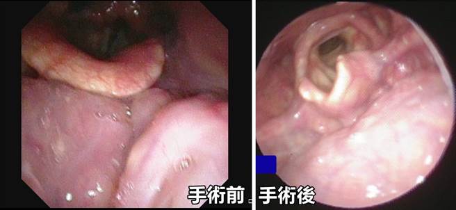 郭姓患者经评估后安排达文西机器手臂手术进行「悬雍垂颚咽成形术」及切除部分肥厚的舌根扁桃淋巴组织，术后呼吸道管径也变大。（亚大医院提供／冯惠宜台中传真）