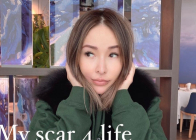 萧亚轩虽在意脸上伤疤，但粉丝们则认为她的近况不错。（图／取自萧亚轩IG）