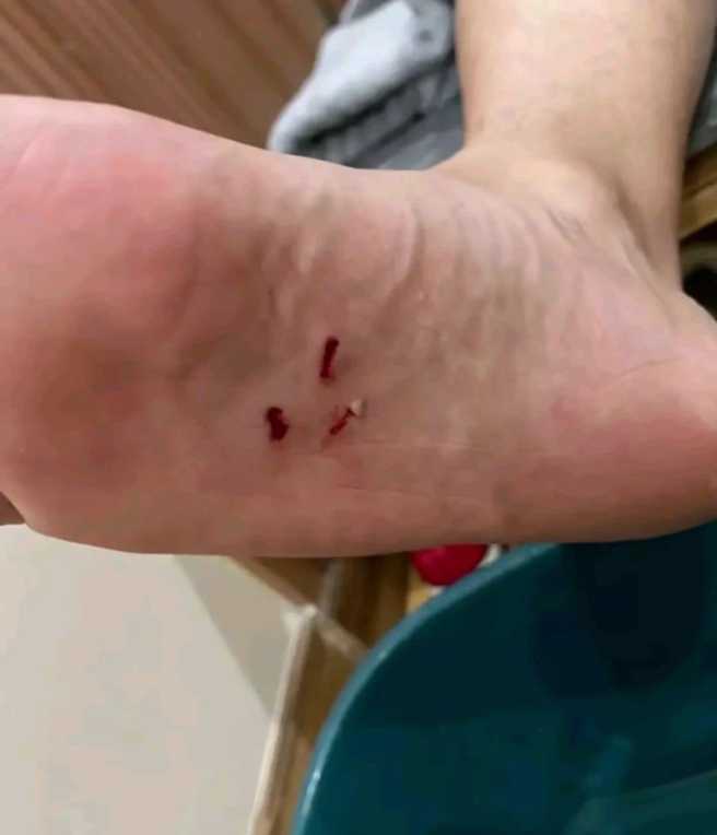 网友日光脚上3个洞的伤口，并拍下地面有1个「头部三角形」后端接着细细长长身体的「物体」，网友猛一看以为是毒蛇，近看才得知原来仅是1条「插头」。（翻摄自脸书「爆废公社二馆」）