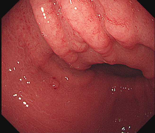 医师林相宏替病患照胃镜，发现胃壁表面有如「苦瓜表面」的小结节突起。（图／翻摄自脸书粉专胰臟医师林相宏）