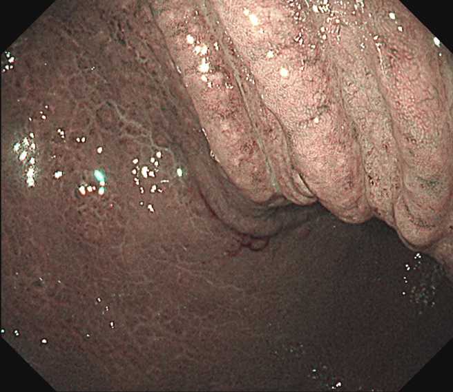 医师林相宏透过强化内视镜检查发现，对方胃表面黏膜已经出现不规则、类似龟裂的样子。（图／翻摄自脸书粉专胰臟医师林相宏）