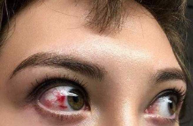 何慈茵近日拍攝槍戰戲時意外受傷。（圖／微博）