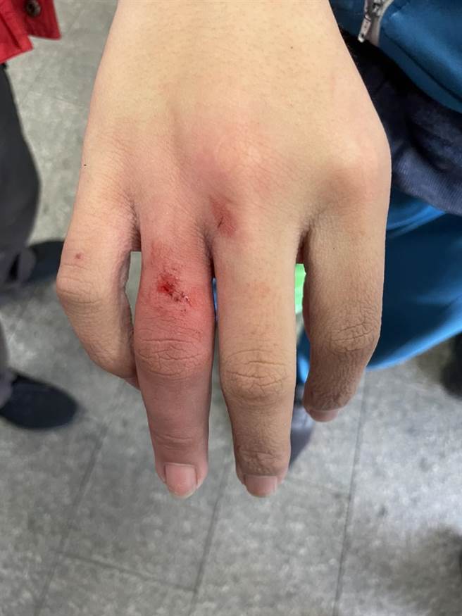 卡指若不及時處理，可能帶來嚴重傷害。（金門縣消防局提供）