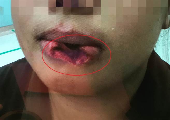 女大生被宠物狗咬伤，口轮匝肌严重撕裂伤，从口腔黏膜到外面下嘴唇整个都劈开来。（亚大医院提供／冯惠宜台中传真）