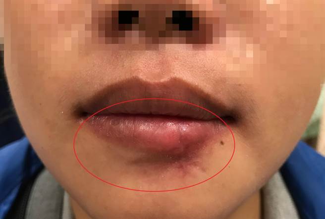 女大生经亚大医院整形外科医师郑旭堂仔细的分层缝合伤口，两周拆线后復原状况良好。（亚大医院提供／冯惠宜台中传真）