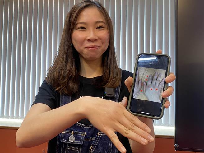 张小姐秀出手机里昔日遭受乾癣性关节炎折磨时手部关节肿胀的照片，鼓励病友，不要放弃，找到正确的治疗方式就不会那么辛苦了。（冯惠宜摄）