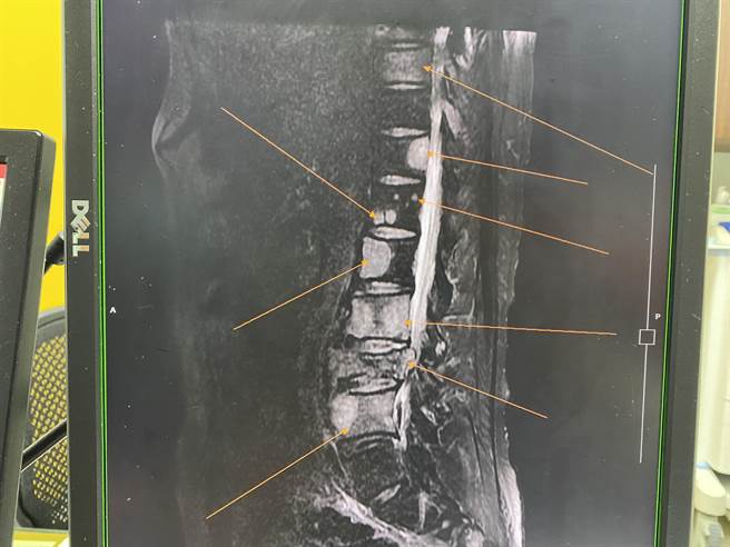 長安醫院副院長、神經外科醫師李漢忠指出，經核磁共振檢查發現患者從胸椎到第五腰椎都有脊椎腫瘤。（長安醫院提供／馮惠宜台中傳真）