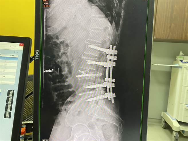 病患進行腰椎椎板切除固定術，目前腰痛腳麻減緩很多，也可以站立行走了。（馮惠宜攝）