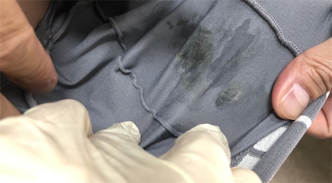 青少年对性好奇，约炮床战尝禁果，却不注意安全性行为的防护，导致经由体液接触感染淋病，下体化脓发炎，滴落的黄绿色分泌物沾染到内裤。（陈昭安医师提供／谢琼云彰化传真）