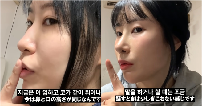 南韩谐星李世英近日公开自己接受整形的过程。（图／YOUTUBE）