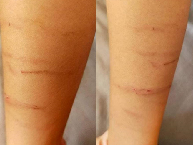 金门1名母亲控诉，她的孩子因在学校上课时偷玩橡皮筋，被班导师叫去办公室后，班导师用橡皮筋套住孩子手腕，再将橡皮筋拉高放手，作为处罚。（翻摄自脸书「爆料公社」）