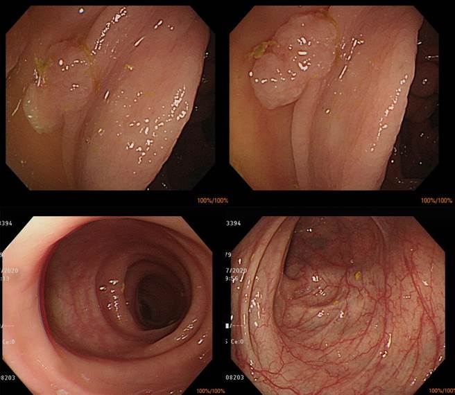 研究团队给予受试人员服用以「宫入菌」（CBM588）为主成分的益生菌，一年后大肠腺瘤发生率从70.8％明显下降至31.3％，切除者（上图为切除前）的大肠也获得稳定控制，没有復发迹象（下图）。（高医提供／袁庭尧高雄传真）