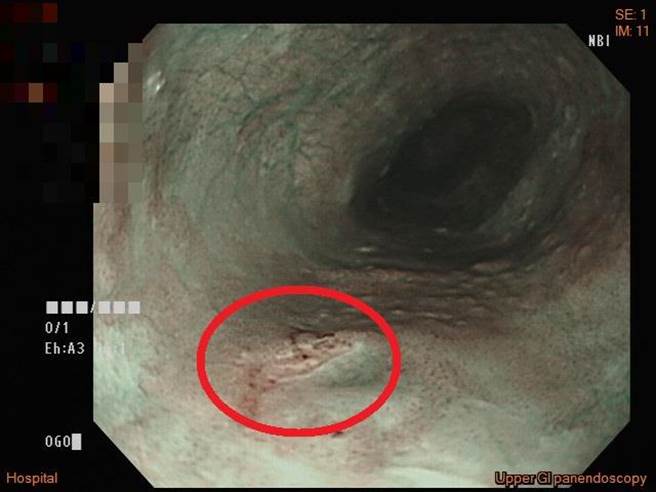 透过内视镜窄频光源系统 (Narrow Band Imaging; NBI) 下之同一病灶的影像，可以明显看出病灶之范围及表面。（长安医院提供／冯惠宜台中传真）