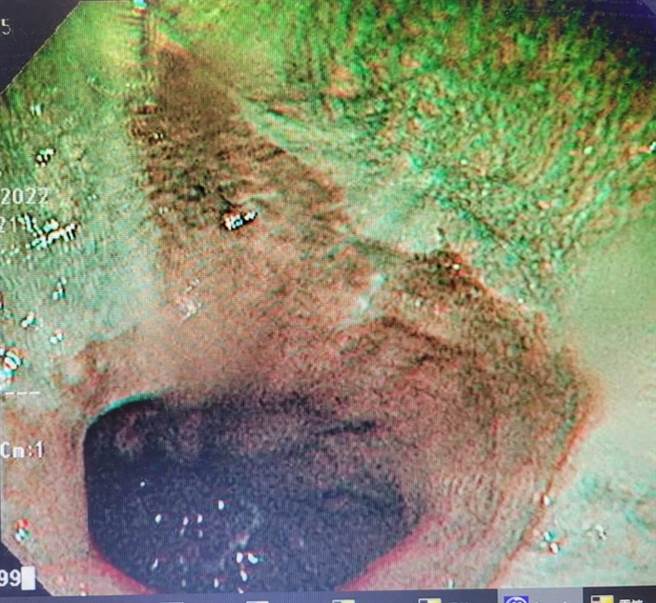 黑色部分为胃食道逆流造成的粘膜缺损。（阮综合医院提供／袁庭尧高雄传真）