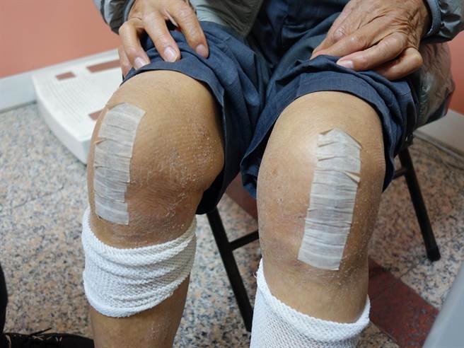 雷老先生術後回診拉起褲管，對手術的結果很滿意。（李綜合醫院提供）