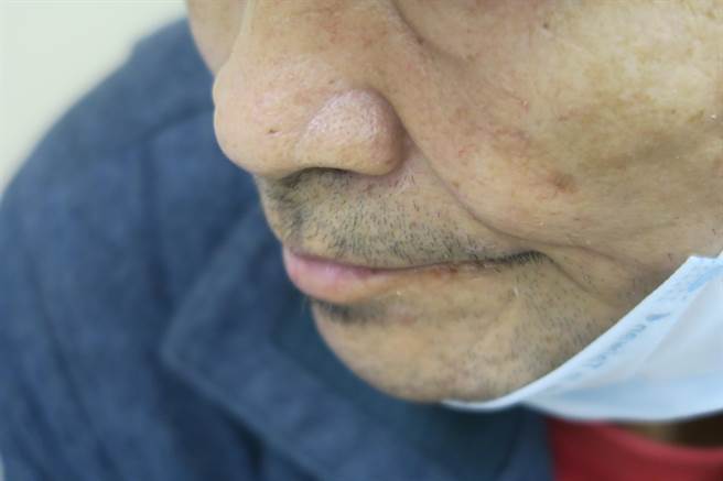 锺男的左侧鼻子严重鼻塞、无法呼吸，还影响说话，让人听不清楚。（院方提供／谢琼云彰化传真）