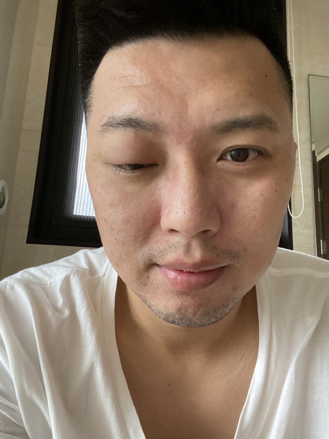 林宜辉眼部伤势状况。（攻城狮提供）