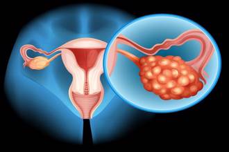 常脹氣便秘 小腹婆竟是卵巢癌  4大症狀恐已後期