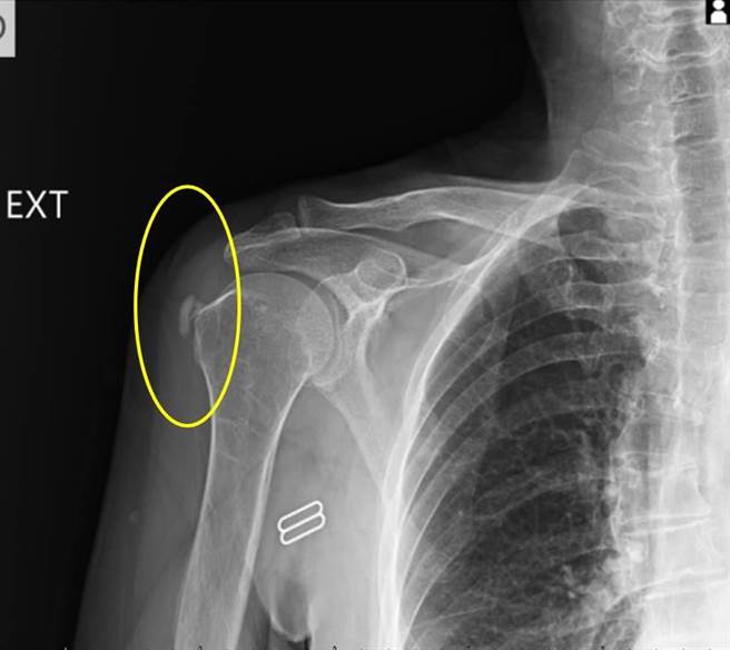 震波前患者钙化性肌腱炎的情形。（丰原医院提供）