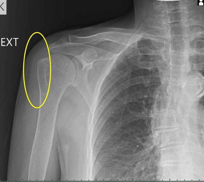 接受震波治疗一个月后，钙化完全消失。（丰原医院提供）