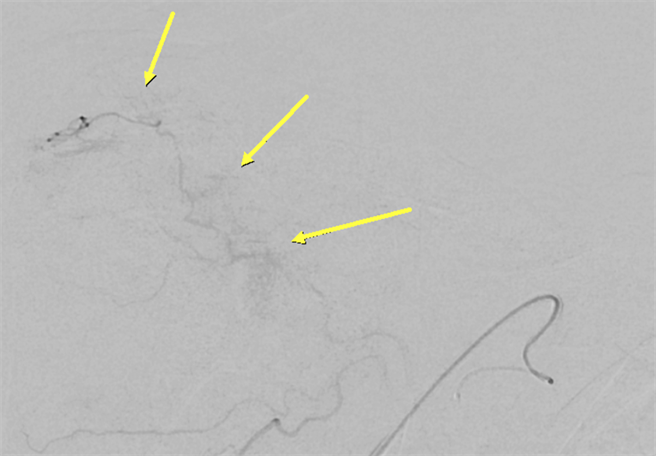 黃色箭頭為肩膀部位發炎組織新生成異常的微小血管。（梧棲童醫院提供）