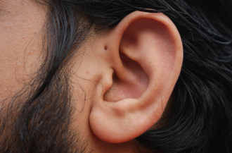 邵雨薇自曝耳上的小黑洞  「耳前廔管」竟是先天性疾病