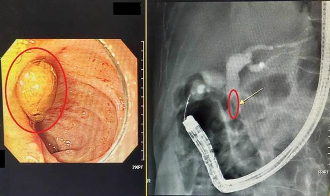 陳姓老翁因黃疸症狀就醫，檢查發現總膽管出現一顆結石(紅圈處)。（大千醫院提供／謝明俊苗栗傳真）