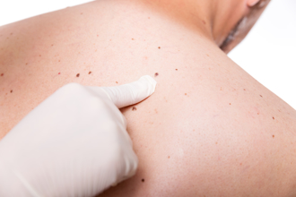 皮膚癌有5大徵兆  醫曝自我檢測法：這是奪命痣！