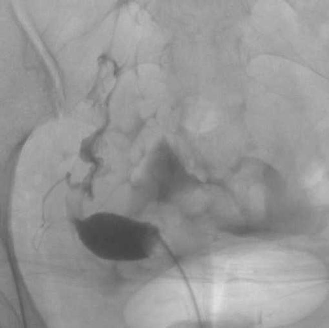大方公开单角子宫的输卵管摄影照，陈伶宣乐观称自己是「独角兽」。（图／陈伶宣提供）