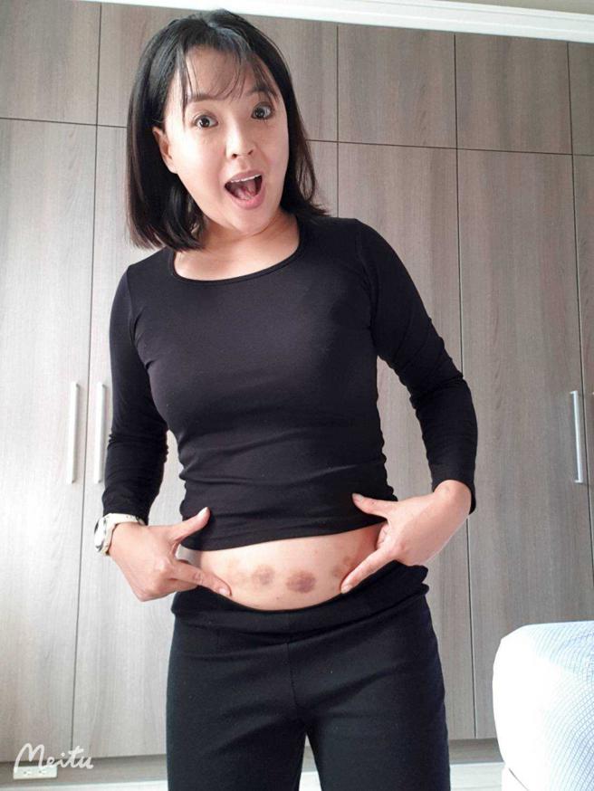 陈伶宣受孕两周的照片，肚皮上清晰可见打针留下的瘀青。（图／陈伶宣提供）