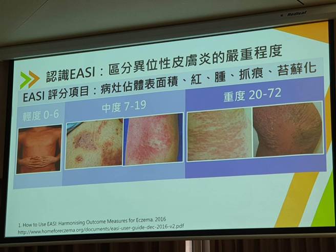 异位性皮肤炎的严重程度，临床多採「EASI评分标准」，依据皮肤红肿、抓痕、苔癣化等症状的分布面积，划分为3个等级，EASI评分0-6，属于「轻度」；7-19分属于「中度」；20-72分则为「重度」。（陈人齐摄）
