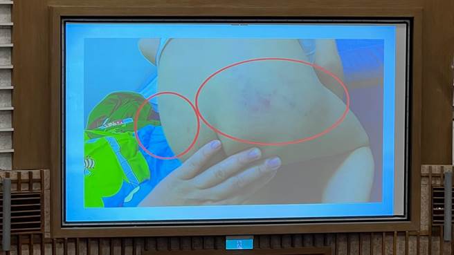 1名家长发现4岁女童屁股肿胀、瘀青，经调阅幼儿园监视器发现，竟被老师及助教暴打。（柯宗纬摄）