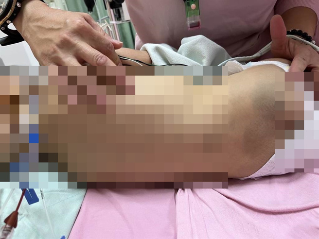 男嬰母親表示，夏姓保母坦承男嬰後背的瘀青是她弄的。（家屬提供）