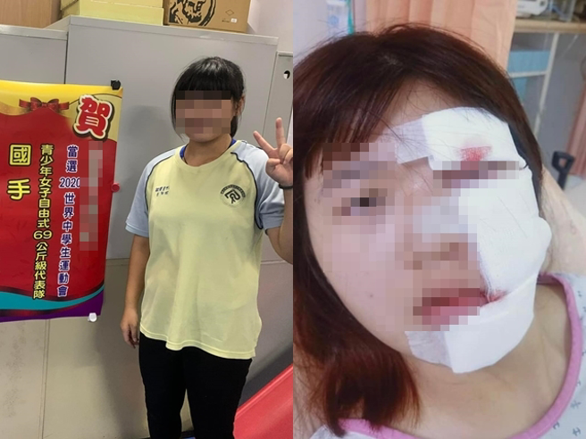 該女國手騎車遭右轉車輛撞上、顴骨粉碎，目前臉部仍不時腫脹，甚至會在路上暈眩，肇事女駕駛稱是對方未注意車況衝撞她，索討500萬精神賠償。（翻攝自臉書「爆料公社」）