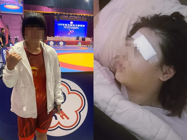 該女國手騎車遭右轉車輛撞上、顴骨粉碎，目前臉部仍不時腫脹，甚至會在路上暈眩，肇事女駕駛稱是對方未注意車況衝撞她，索討500萬精神賠償。（翻攝自臉書「爆料公社」）