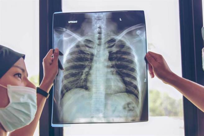 这检查让早期肺癌无所遁形！医：已成筛检黄金标准。(示意图/Shutterstock)