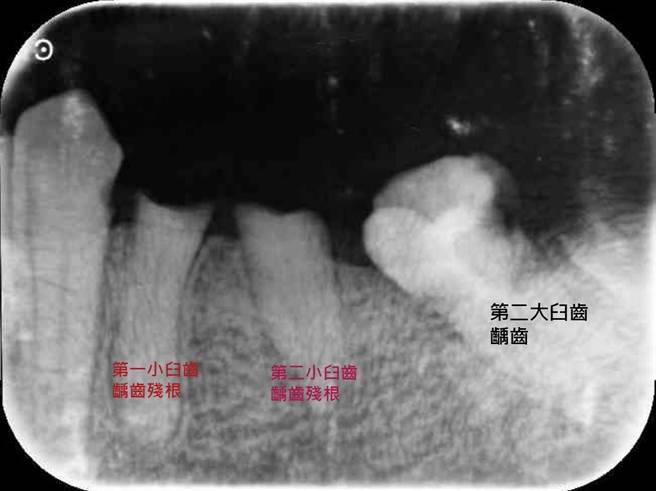 78歲臥床患者因左下側齲齒殘根併發蜂窩性組織炎感染到台中醫院緊急就醫。（台中醫院提供）