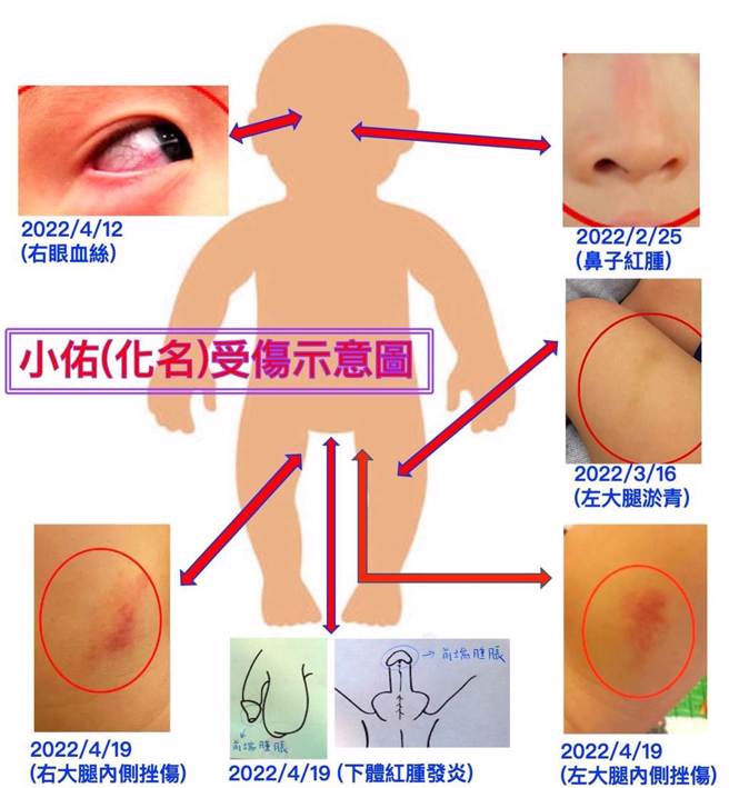 立委何欣纯服务处副主任赖美莲指出，男童从今年2月间就陆续身上出现不明伤痕。（立委何欣纯服务处提供）