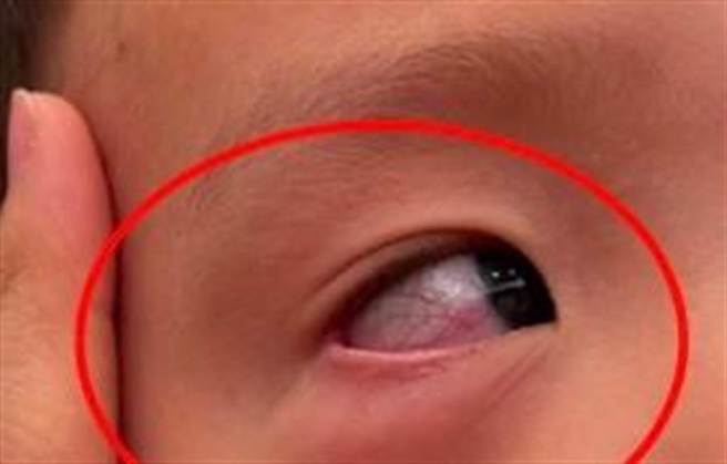 男童4月12日右眼出现血丝。（立委何欣纯服务处提供）