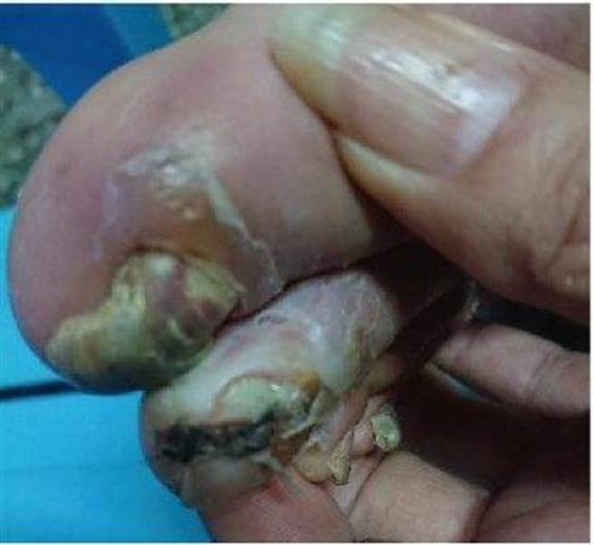 本身有糖尿病史的50岁张伯伯左脚大拇指伤口迟迟未癒合。（亚大医院提供）