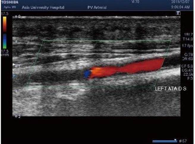 50岁张伯伯左脚大拇指伤口迟迟未癒合，经到亚大医院透过周边血管超音波检查，发现是左腿小腿动脉狭窄。（亚大医院提供）
