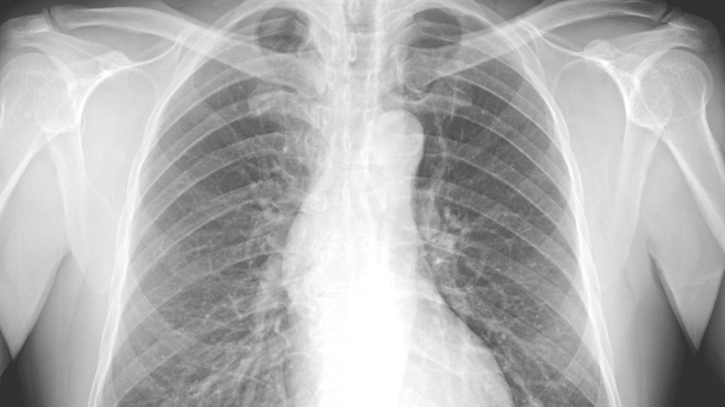 医师苏一峰表示，一名男子主诉有咳嗽、流鼻水及痰多等症状，经肺部X光后发现有肺炎情况，男子随后说，同住家人也有相同病症，但却因为买不到快筛，无法筛检。（图／翻摄自苏一峰脸书）