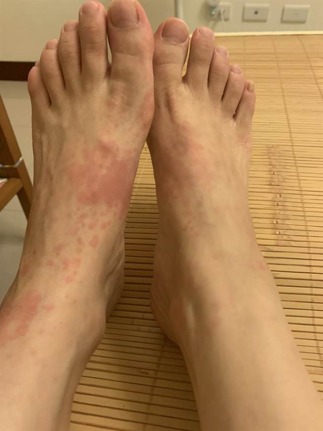 成人史迪尔氏症候群，在临床上患者全身上下会出现大小不一的鲑鱼色斑丘疹。（亚大医院提供／卢金足台中传真）